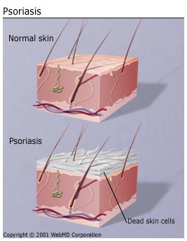 DÍA MUNDIAL DE LA PSORIASIS